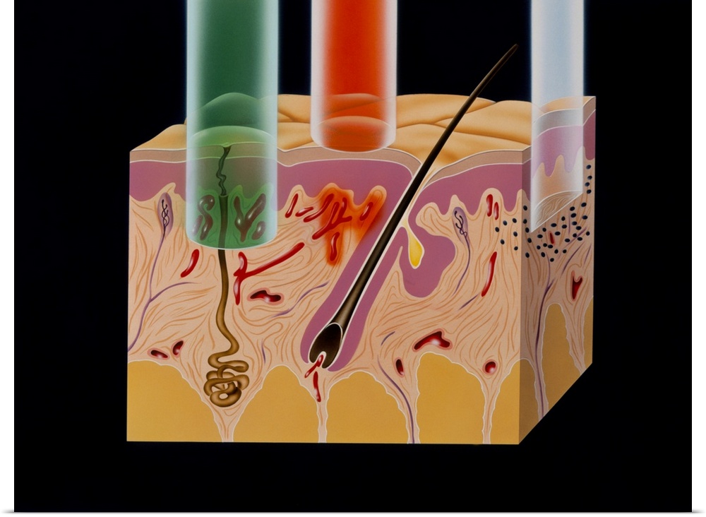 Artwork of a section of human skin showing the relative degree of penetration of three types of laser beams used in medici...