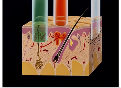 Artwork: penetration of skin by various lasers