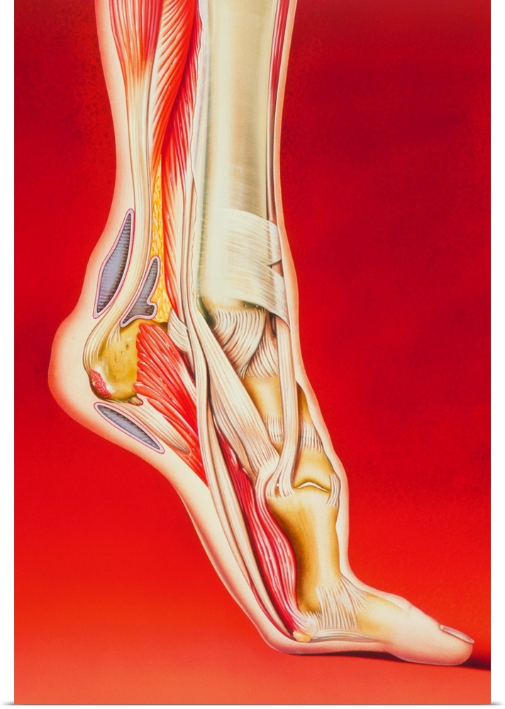 Calcaneal spur and foot pain. Illustration showing causes of pain in the foot. At top left are the calf muscles which atta...