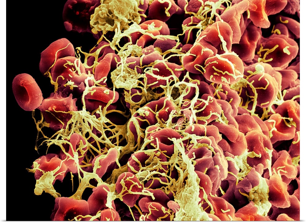 Blood clot. Coloured scanning electron micrograph (SEM) of a blood clot beginning to form. Red blood cells (erythrocytes, ...