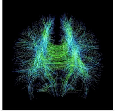 Brain fibres, DTI MRI scan