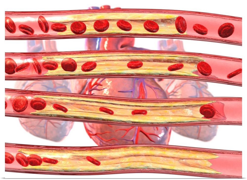 Coronary artery disease. Computer artwork of red blood cells flowing through an increasingly (top to bottom) blocked coron...