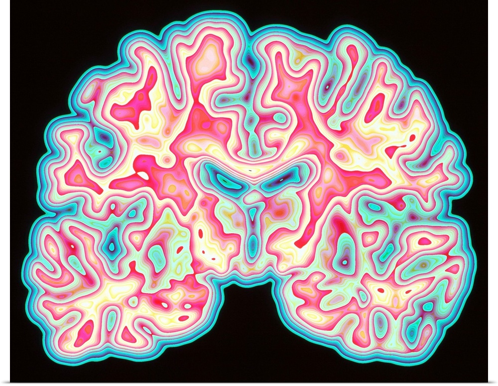 Brain. Coloured computed tomography (CT) scan of a section through a healthy human brain. The heavily-folded cerebrum is s...