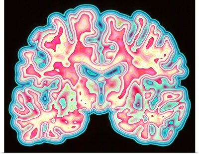 CT scan of brain