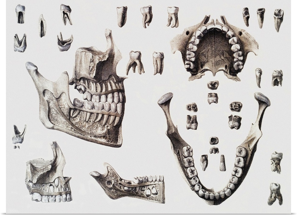 Dental anatomy. Historical anatomical artwork of healthy and diseased human teeth and jaws. The teeth and jaws are seen fr...
