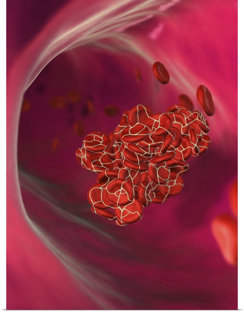 Detached blood clot. Computer artwork of an embolus (detached blood clot) in a blood vessel. The erythrocytes (red blood c...