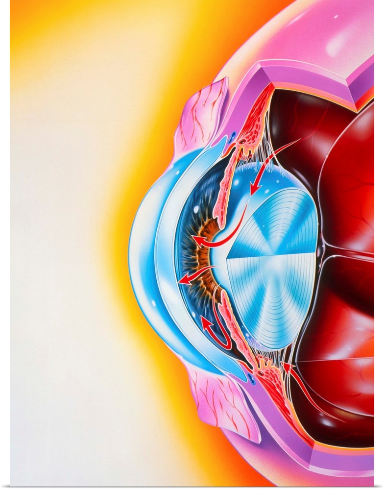 Glaucoma. Artwork showing the flow of the watery aqueous humour (arrows) in a human eye with glaucoma, abnormally high pre...