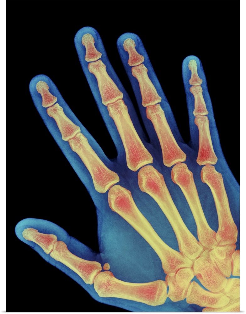 Healthy hand. Coloured X-ray of the healthy hand of a 60 year old man, showing the skeleton of bones. The fleshy outline o...