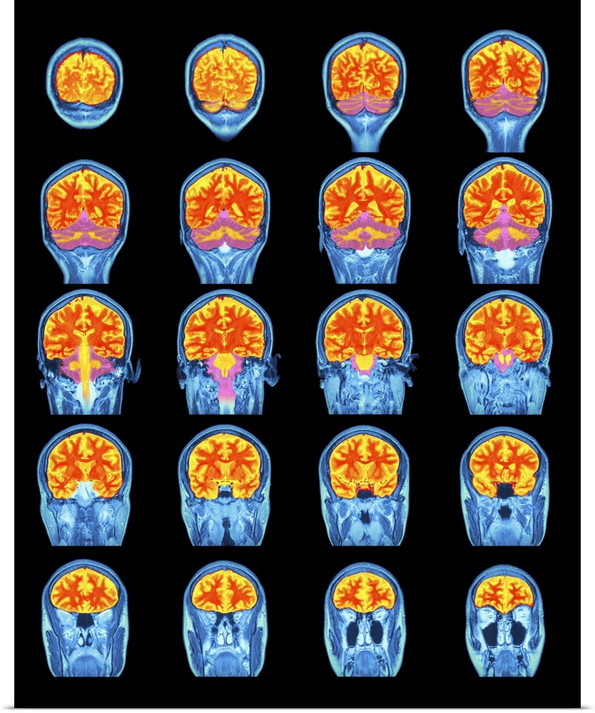 Poster Print Wall Art entitled Healthy brain, MRI scans | eBay