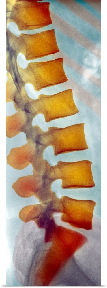 Healthy spine. Coloured X-ray of a side view of the healthy lower (lumbar) spine of an adult man. The front of the body is...