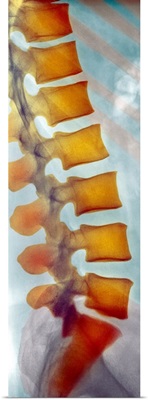 Healthy lower spine, X-ray