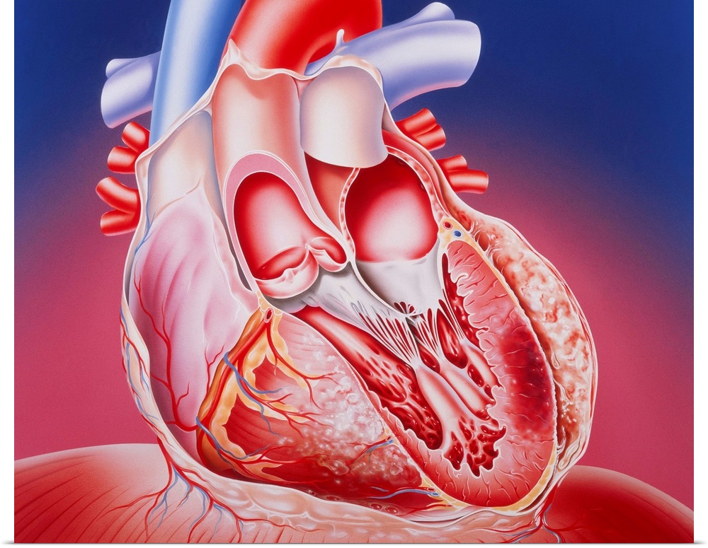 Post-infarction heart. Illustration of a partly dissected human heart showing muscle damage caused by a myocardial infarct...