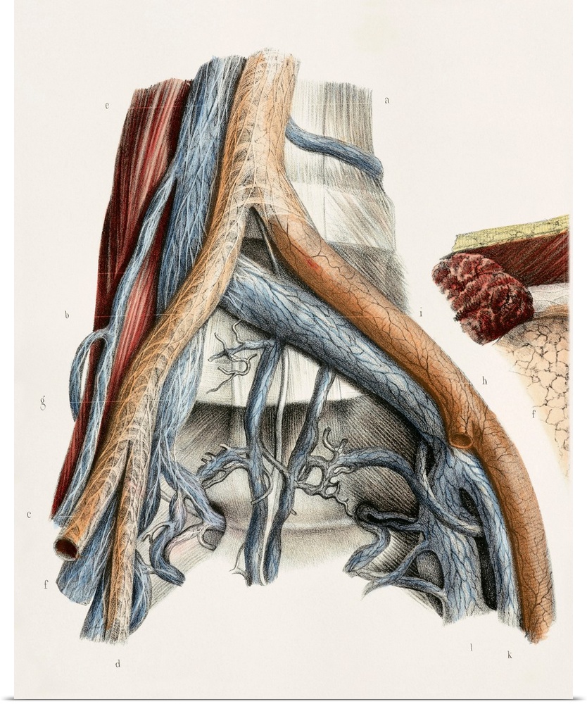 Iliac blood vessel nerves. This anatomical artwork is figure 3, plate 96 from volume 3 (1844) of 'Traite complet de l'anat...