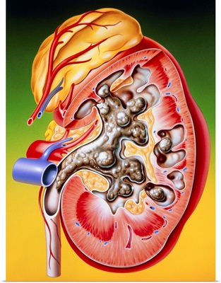 Illustration of a calculus or stone in the kidney