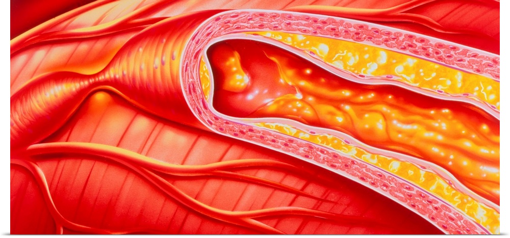 Atherosclerosis. Illustration of branches of a coronary artery on the surface of the heart, in which one branch is disease...