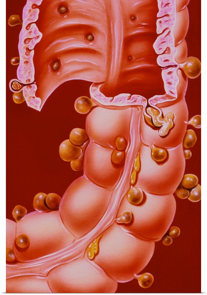 Diverticulitis. Illustration of a region of the descending colon of the human intestine, showing diverticulitis. Also know...