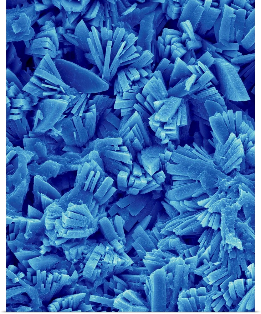Kidney stone, coloured scanning electron micrograph (SEM). Kidney stones are primarily formed by crystallization of the mi...