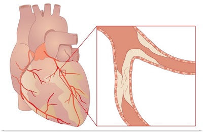 Narrowed coronary artery, artwork