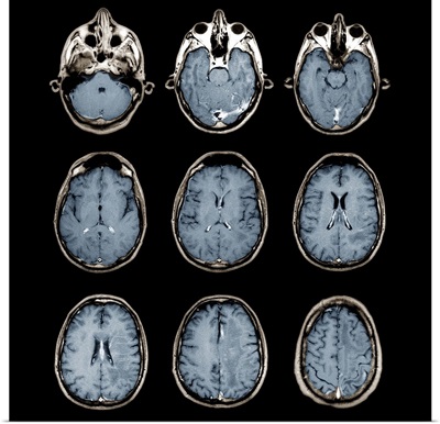 Normal brain, MRI scans