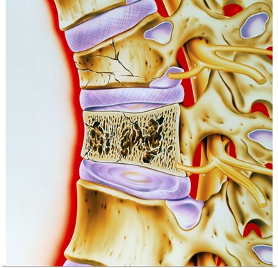 Osteoporitic spine