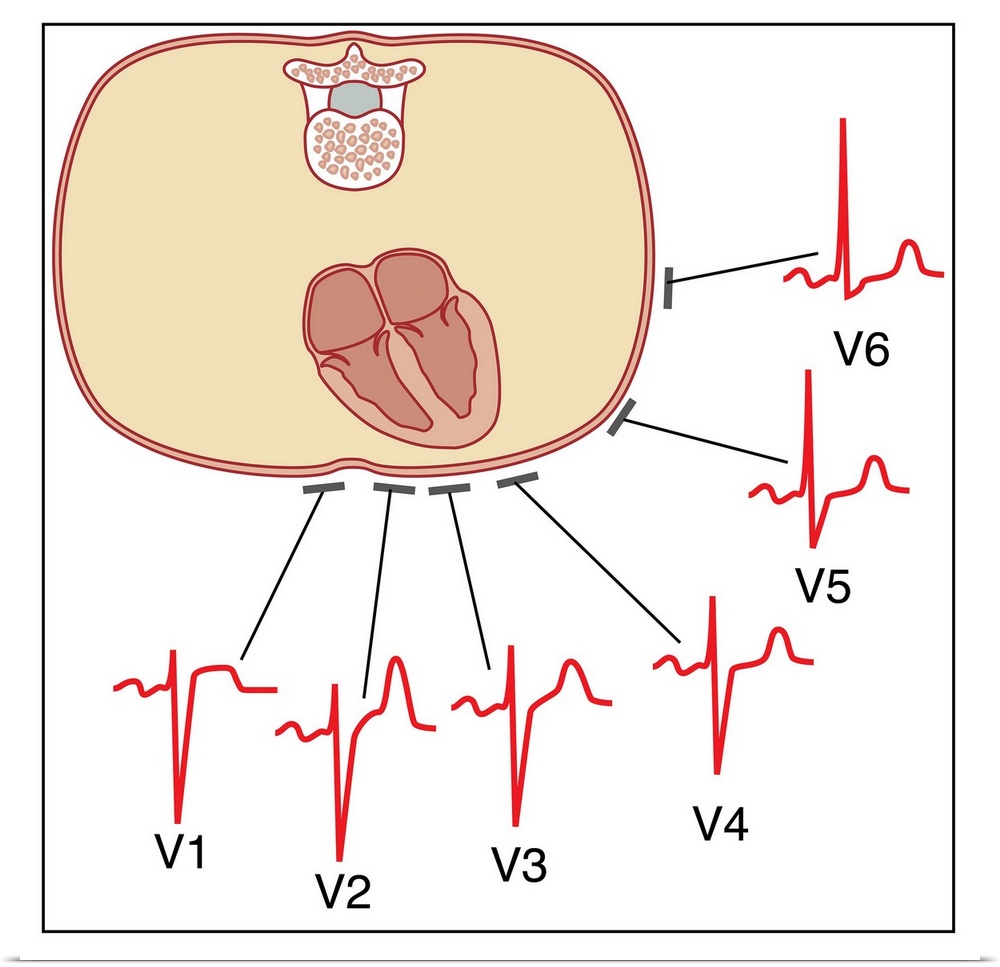 Placing of electrodes for electrocardiogram (ECG), artwork. This diagram shows where the six electrodes attached to the ch...