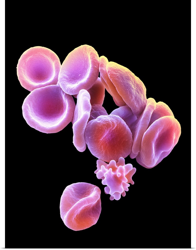 Red blood cells. Coloured scanning electron micrograph (SEM) of red blood cells (RBCs, erythrocytes). A single crenated re...