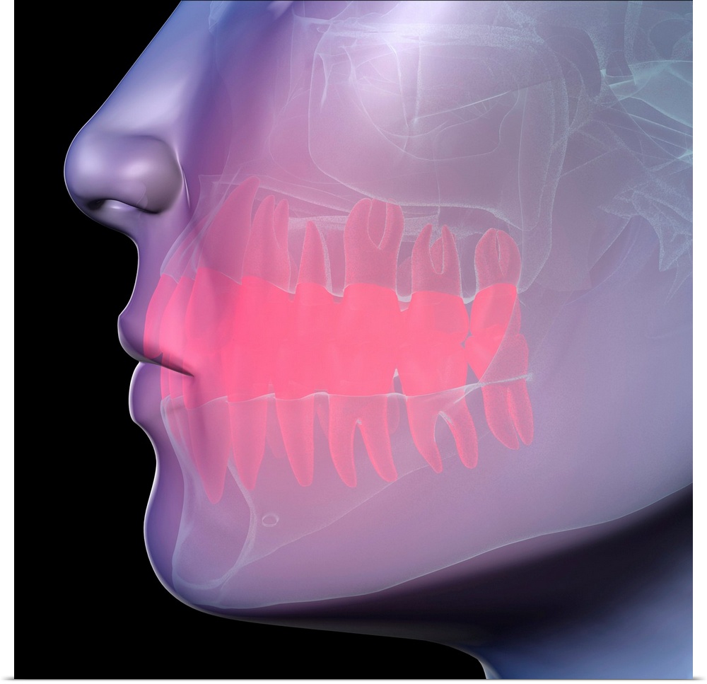 Toothache. Conceptual computer artwork showing pain (represented as the red area) in the teeth. The bones (white) of the m...