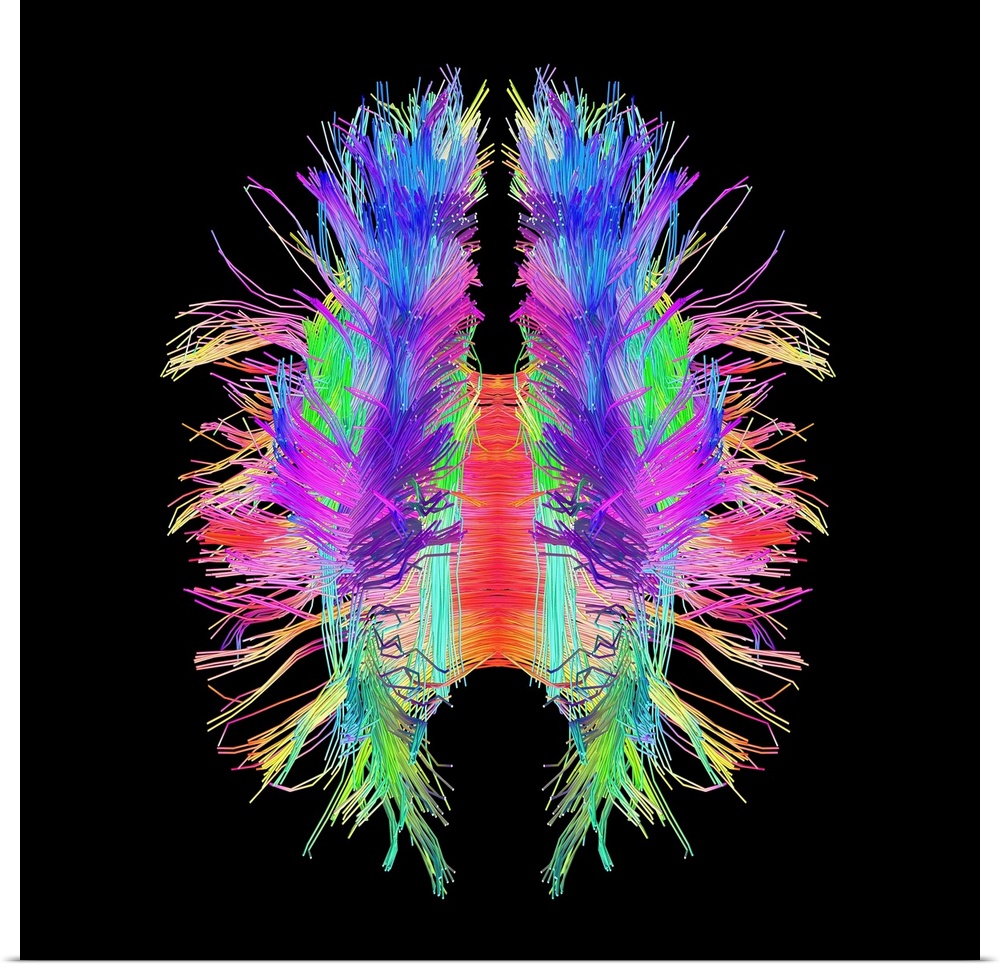 White matter fibres overlaid a 3d model of the human brain in top view. Coloured 3D diffusion spectral imaging (DSI) scan ...