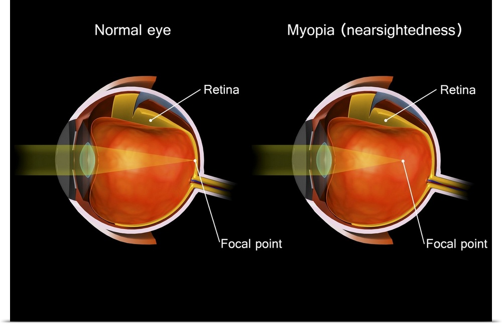 Comparison of a normal eye and an eye with myopia.