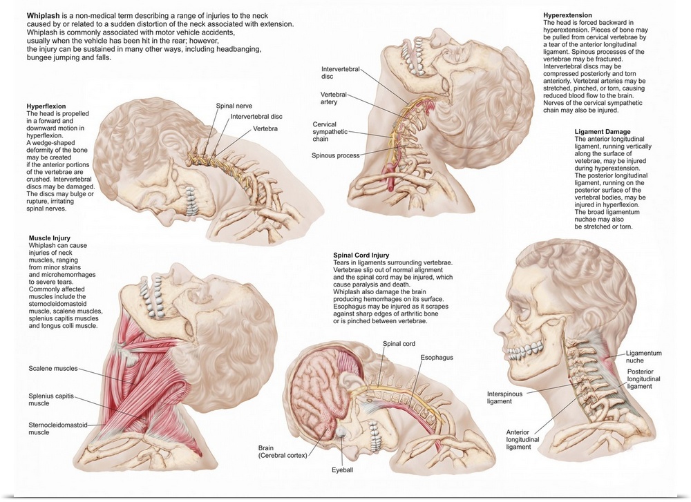 Medical chart showing the range of injuries to the human neck caused by whiplash.