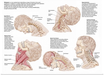 Medical chart showing the range of injuries to the human neck caused by whiplash