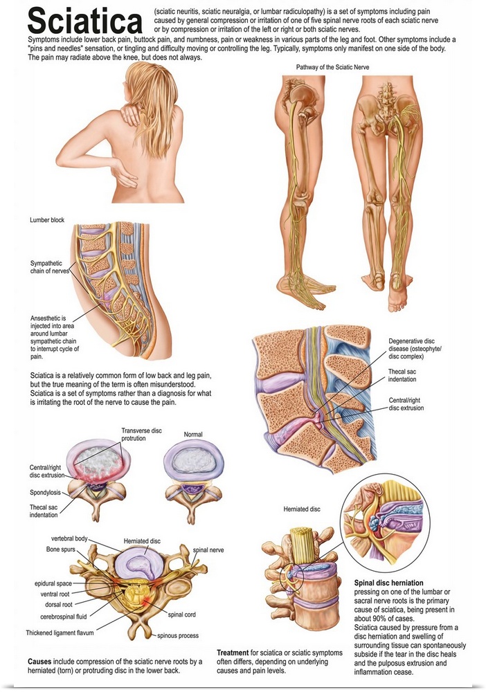 Medical chart showing the signs and symptoms of sciatica.