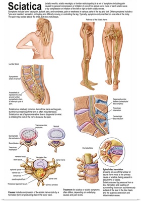 Medical chart showing the signs and symptoms of sciatica