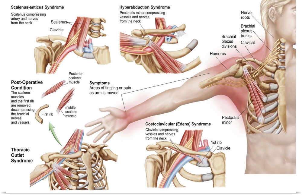 Medical illustration detailing thoracic outlet syndrome.