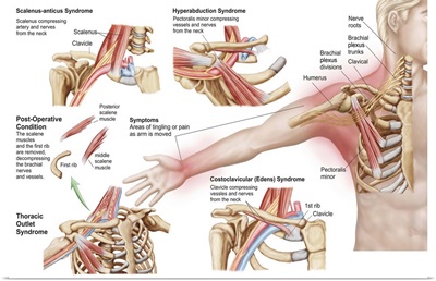 Medical illustration detailing thoracic outlet syndrome