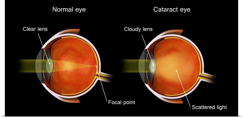 Medical illustration of a cataract in the human eye, compared to a normal eye.