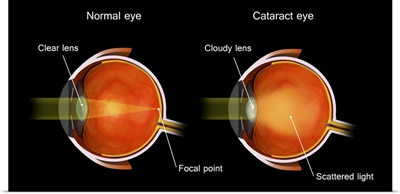 Medical Illustration Of A Cataract In The Human Eye, Compared To A Normal Eye