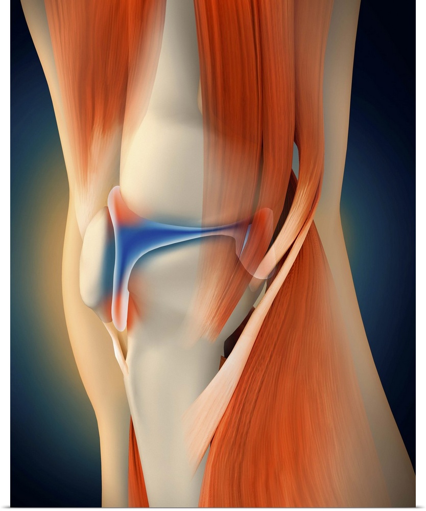 Medical illustration showing inflammation and pain in human knee joint, perspective view.