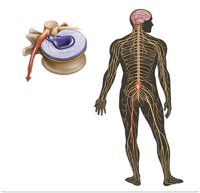 Sciatica caused from herniated disc