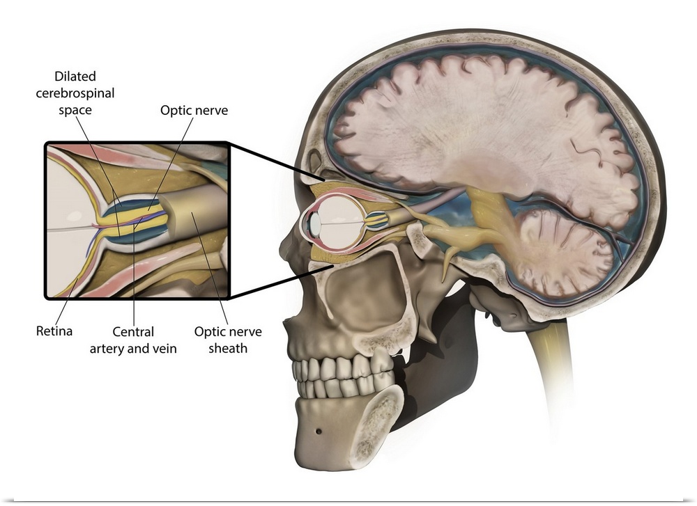 Medical concept shows swelling of the optic nerve caused by increased intracranial pressure.