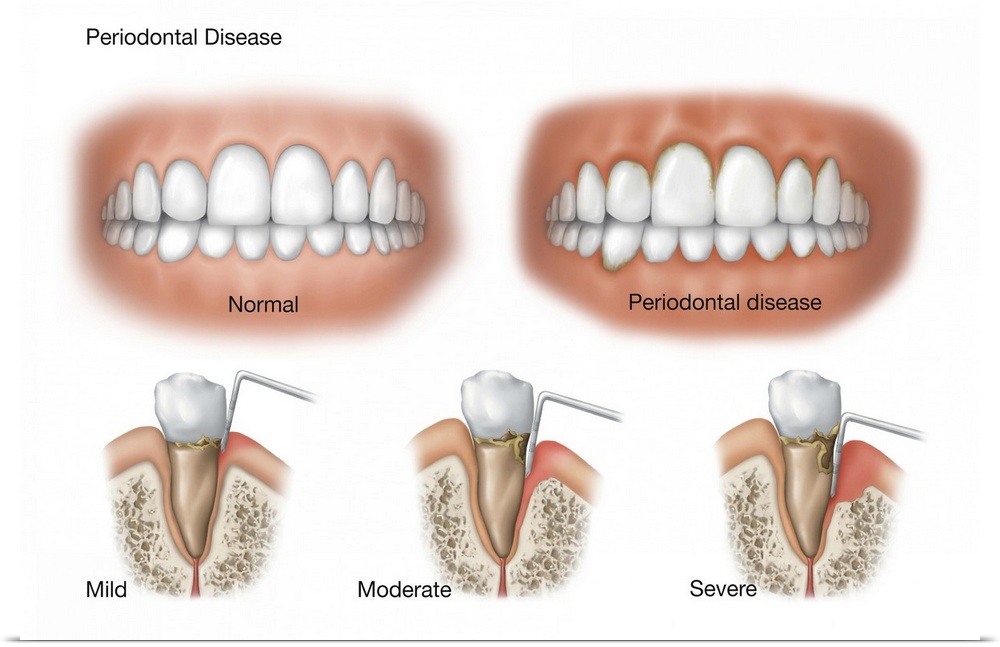 Three stages of periodontal disease.