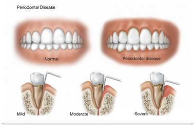 Three stages of periodontal disease