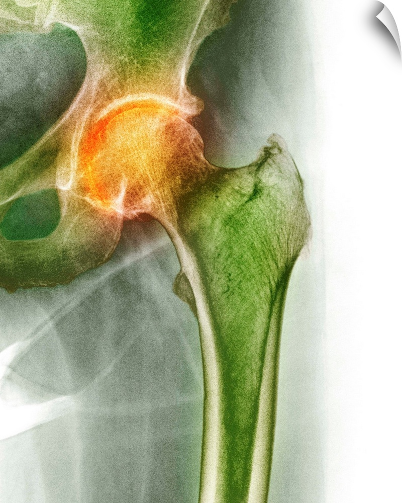 Arthritis of the hip. Coloured X-ray of an arthritic hip.