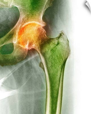 Arthritis of the hip, X-ray