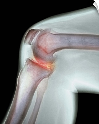 Arthritis of the knee, X-ray