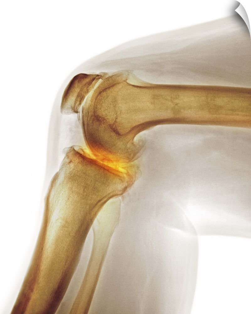Arthritis of the knee. Coloured X-ray the arthritic knee of a 37 year old man. The knee had previously been damaged in a m...