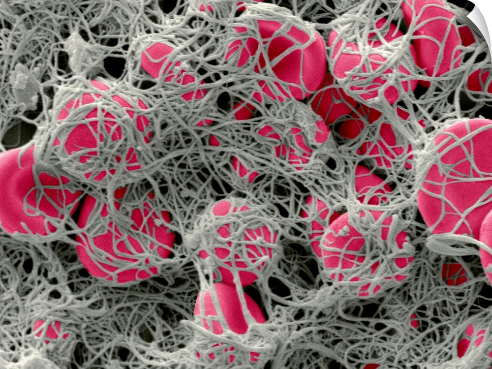 Blood clot. Coloured scanning electron micrograph (SEM) of red blood cells (erythrocytes, red) clumped together with fibri...