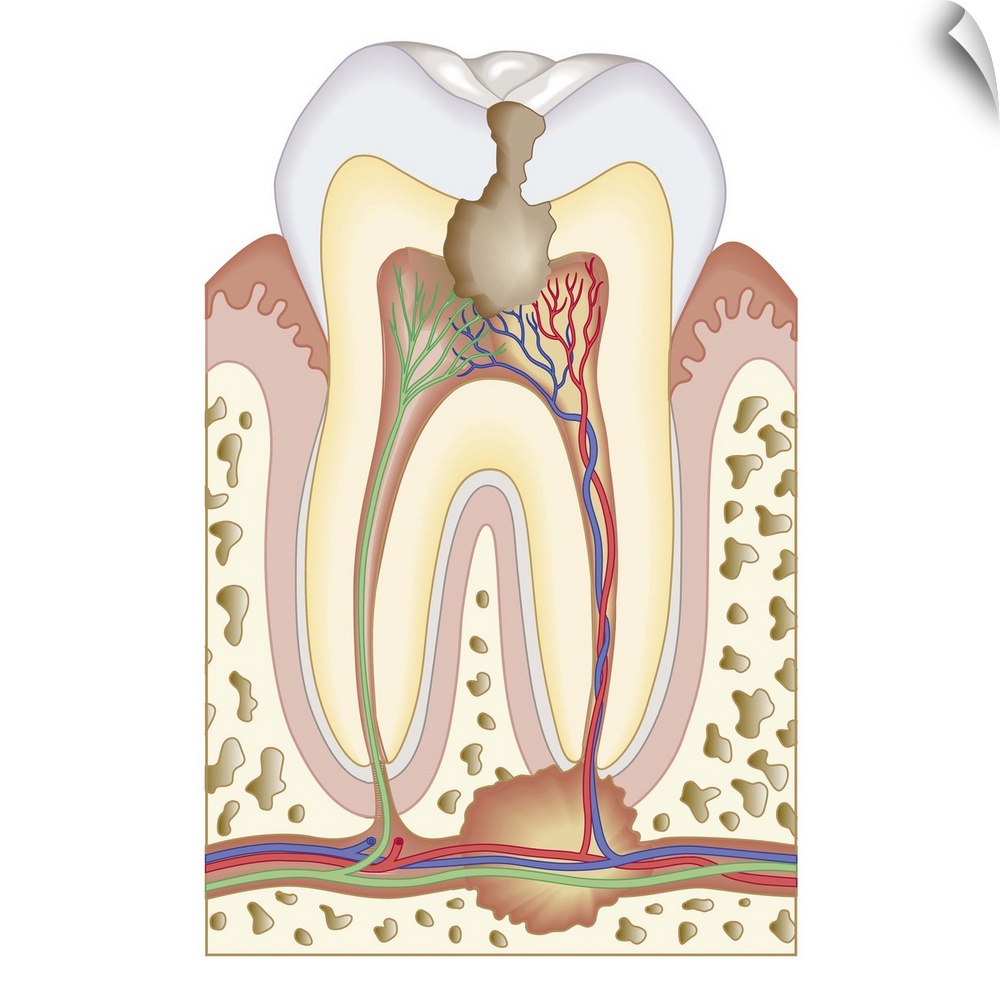 Cross section biomedical illustration of pulp and root abscess in molar