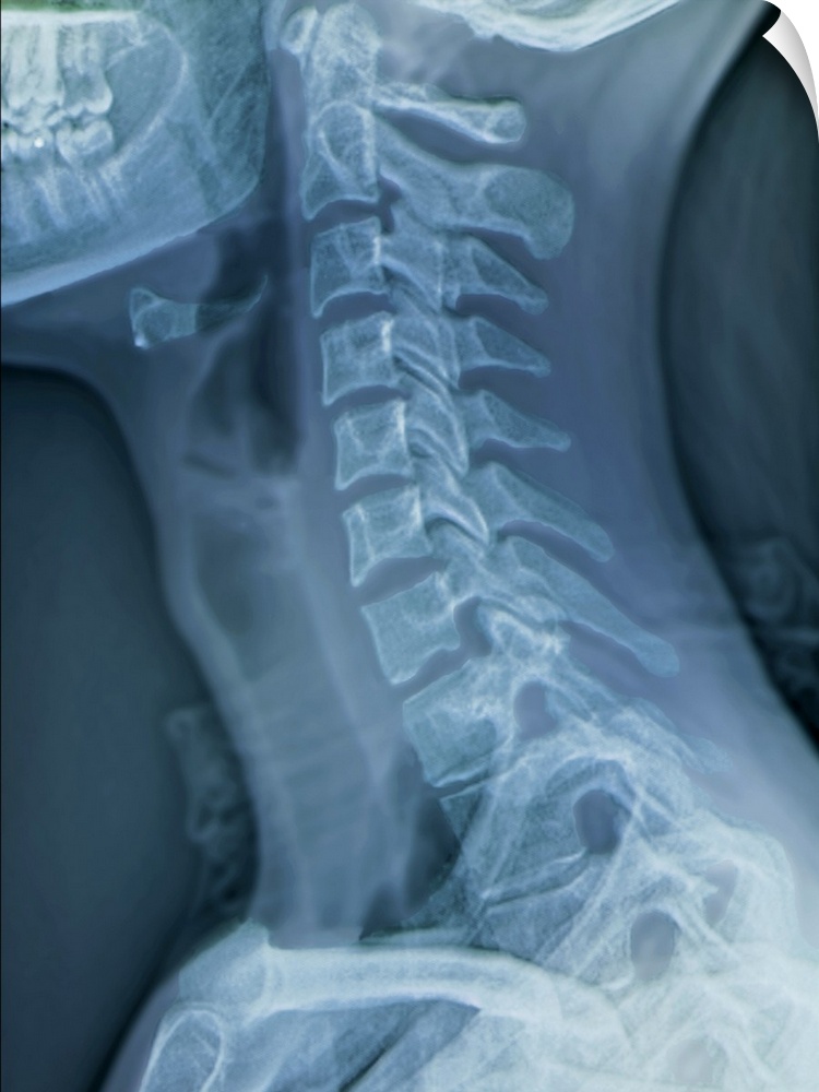 Normal neck. Coloured X-ray of the cervical spine of a 27 year old.