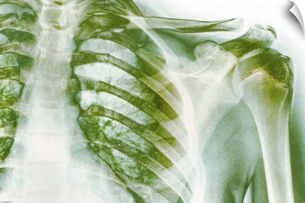 Normal shoulder. Coloured X-ray of the shoulder of a 19 year old man.